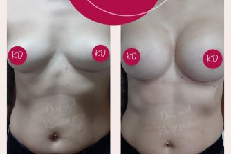 пластична хірургія до після