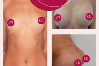 пластична хірургія до після