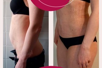 пластична хірургія до після