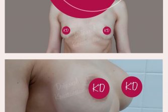 пластична хірургія до після